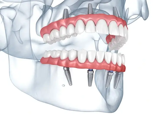 All-On-4 Dental Implants in Tempe | Digital Dentistry Solutions