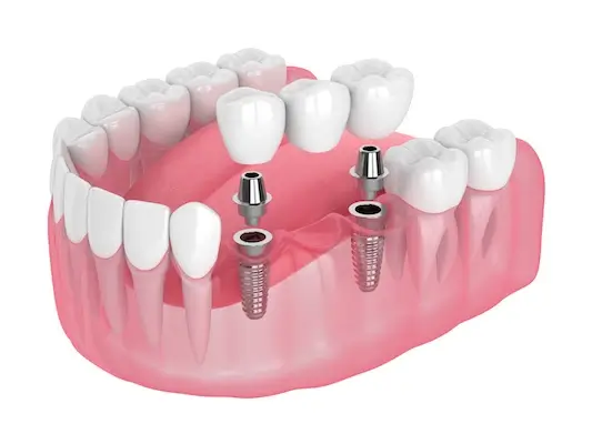 Dental Bridge in Tempe | Digital Dental Solutions