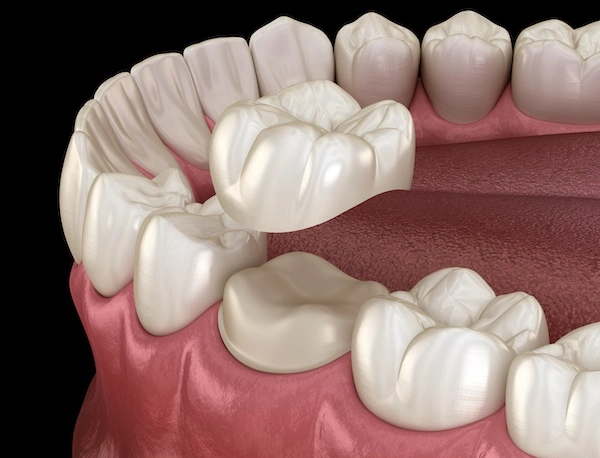 Dental Crowns in Tempe | Digital Dental Solutions | Tempe Dentist